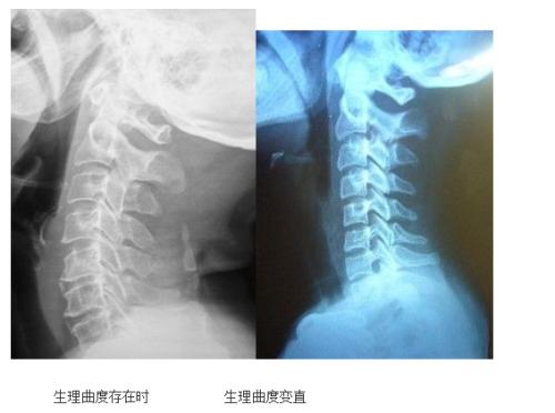 正骨后颈椎生理曲度变直,颈椎曲度变直的正骨治疗