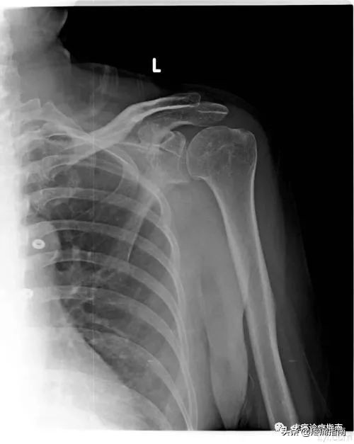 肩关节周围炎的发病原因,肩关节周围炎临床指南