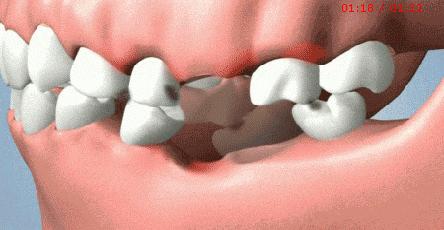 牙缝越来越大是什么导致的,牙缝越来越大什么病中医怎么说