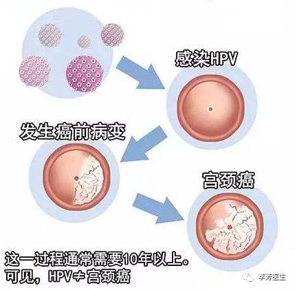 专家谈hpv感染,名医在线hpv