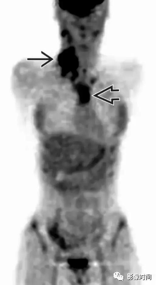 双侧颈动脉鞘间隙多发小淋巴结影,双侧颈动脉间隙多软组织密度结节