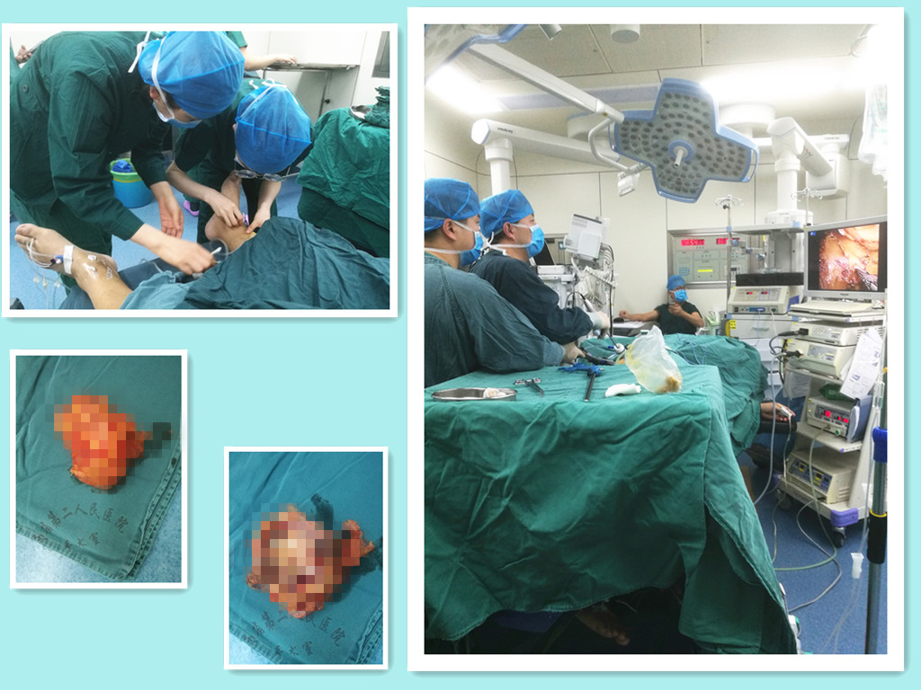 200斤壮汉身患尿毒症合并肾肿瘤省二院3小时微创手术获新生