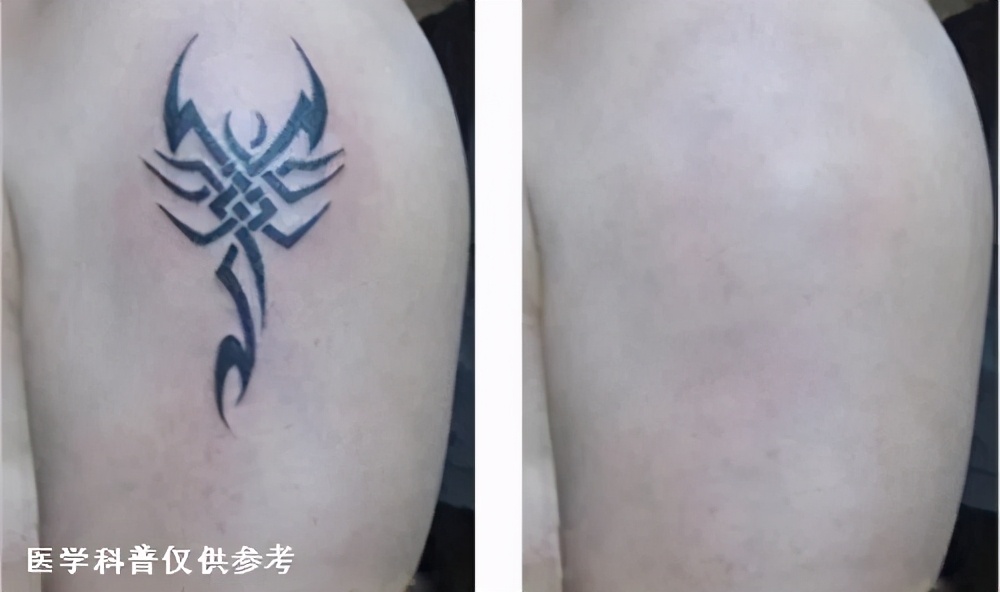 纹身激光去除后可以参军吗,激光去除纹身疤痕可以当兵吗