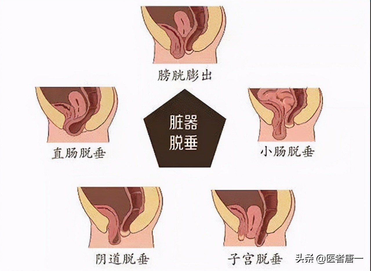 别不好意思做：提肛运动真的很养生，每天做几分钟，男女都受益