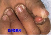 小孩发烧手背发紫是什么原因,宝宝发完烧后眼睛肿是怎么回事