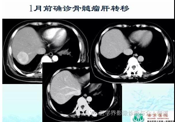 增强ct碘过敏该用什么造影剂,加强ct造影剂过敏皮疹多久能恢复