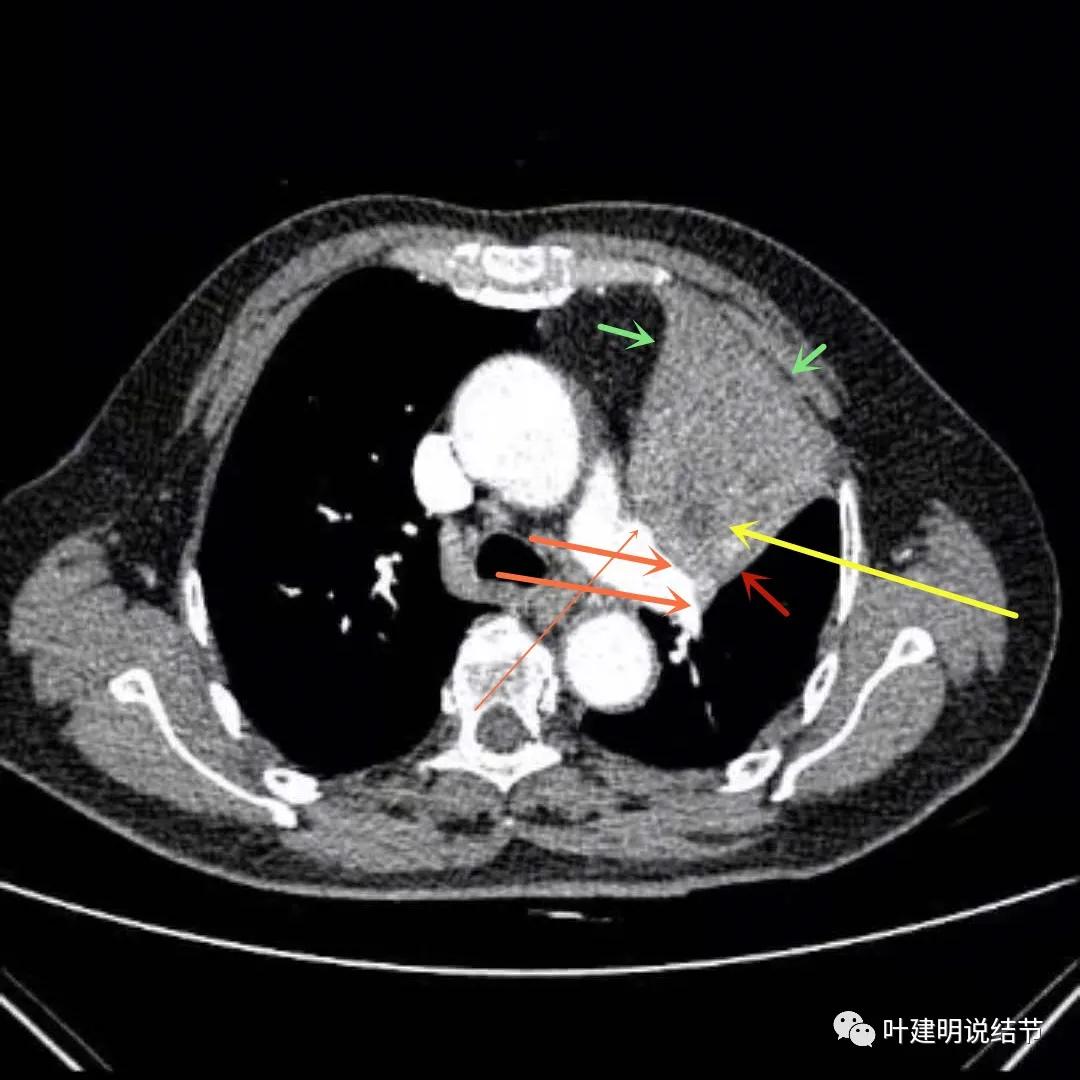 高龄肺癌靶向治疗效果,高龄老人肺癌早期适合放疗吗