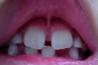 当牙痛遇上疫情怎么办,疫情牙疼得要命