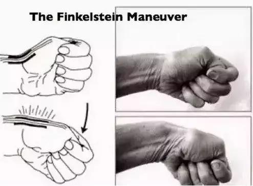 治疗腱鞘炎手腕最快的恢复办法,抱孩子容易得腱鞘炎