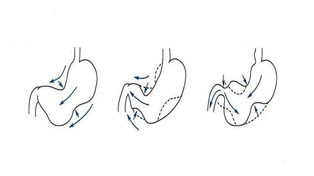 胃痛吃了就吐不排便,突发胃疼吃了胃药不见好转