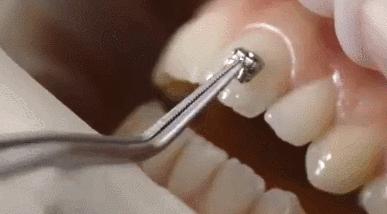 牙齿脱矿涂氟多久可以恢复,牙齿脱矿白斑能自己恢复吗