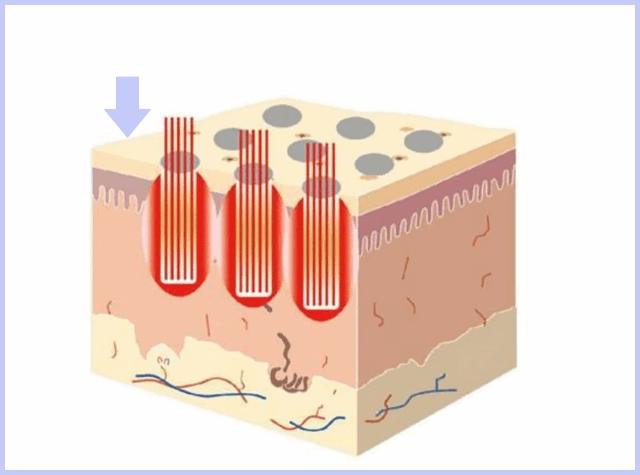 激光照射的注意事项,开关激光