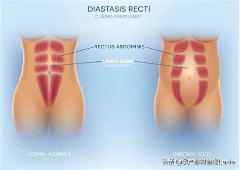 产后腹直肌分离恢复最有效的方法,产后瘦身最快最有效方法