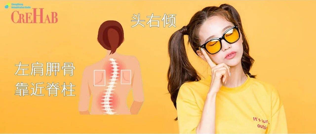 脖子斜颈怎么矫正,如何矫正斜颈