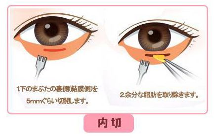 假性眼袋怎么消除简单方法男生,暂时性眼袋