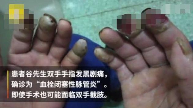 男子长期抽烟突发心梗,男子吸烟导致腿部变黑