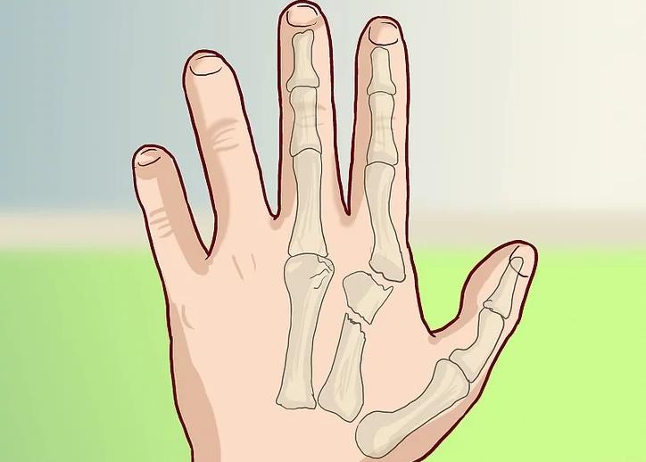 手骨折反复疼痛怎么办,手痛了一个月是骨折吗