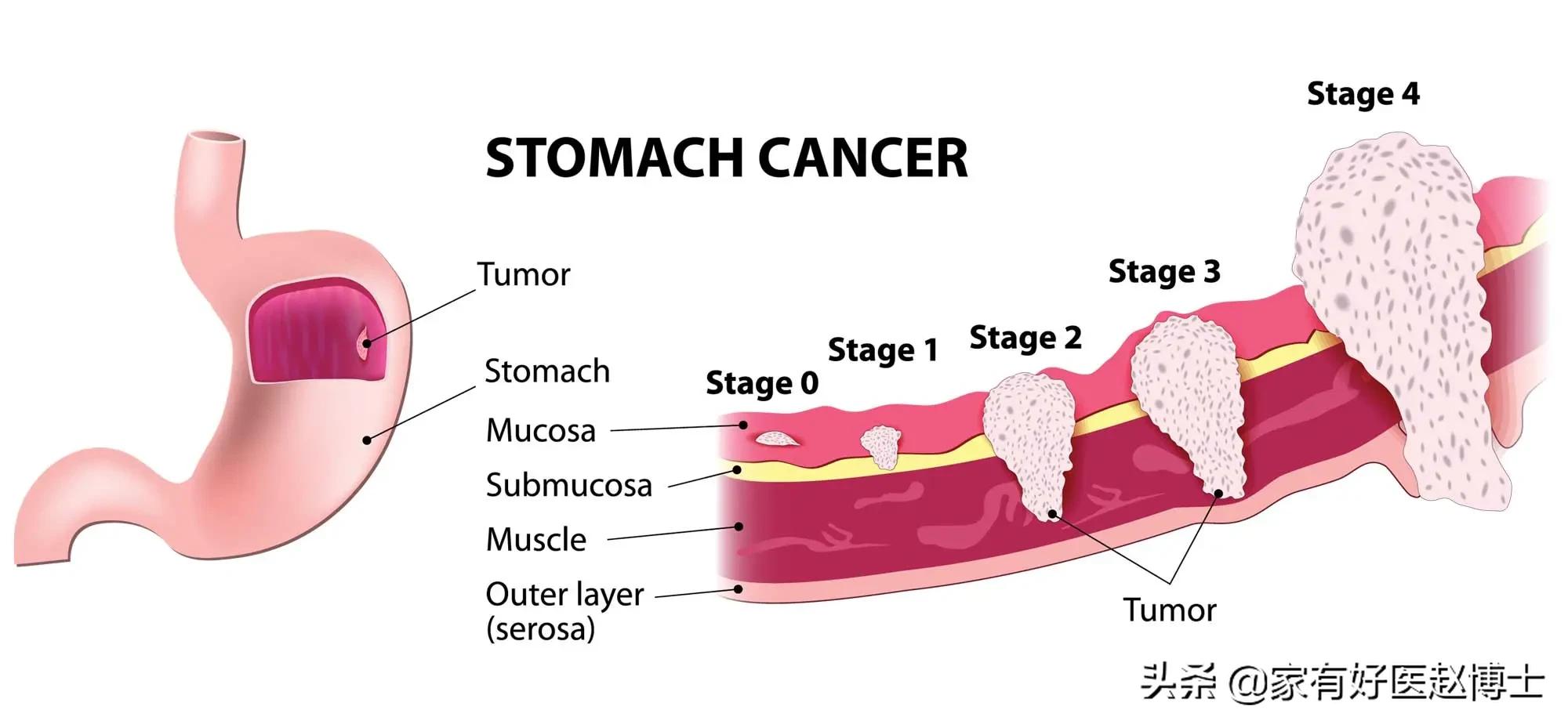 六大高发癌症早筛攻略,六大癌症有哪些