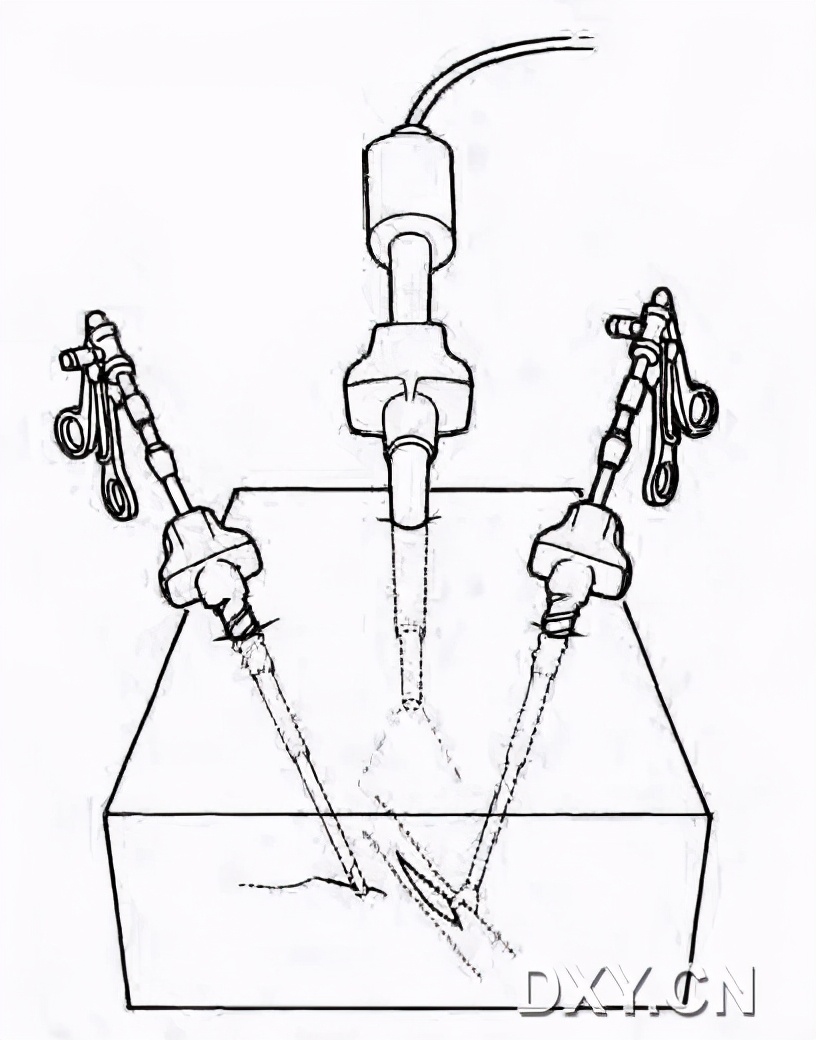 实用大全：腹腔镜下缝合与打结