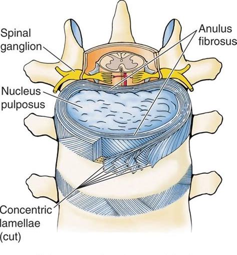 椎间盘的恢复,椎间盘恢复生理曲度方法