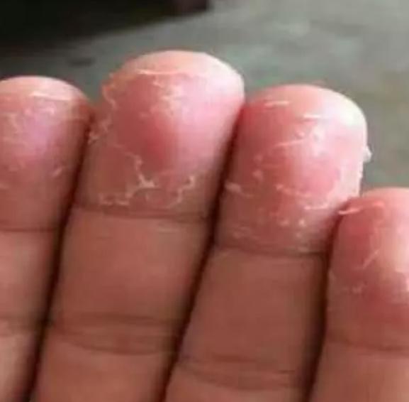 孩子春季手指脱皮是缺什么,手指脱皮是身体求救信号