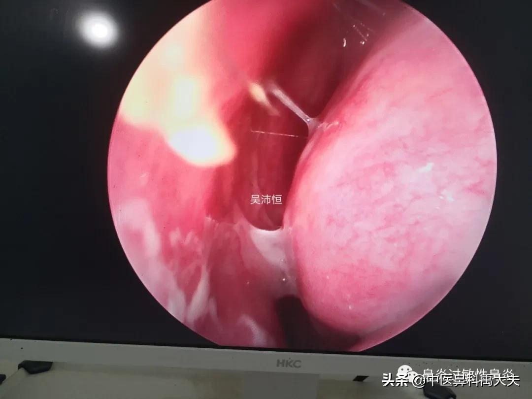 鼻窦炎脓鼻涕绿色头疼,慢性鼻窦炎鼻涕有血怎么办