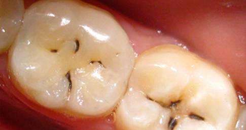 牙齿龋坏究竟要怎么办，补牙之后又能用多久呢？听听看牙医怎么说