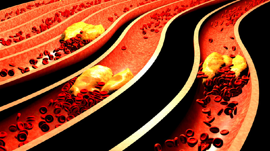 甘油三酯升高可以彻底根治吗,甘油三酯高4.3严重吗