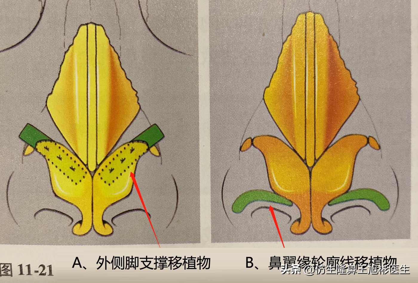 隆鼻的鼻翼怎么修复,隆鼻后多久可以做鼻翼缘矫正