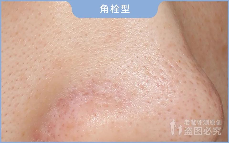 如何用简单的方法去黑头真实有效,别挤了教你去黑头的正确方法