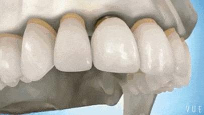 镶牙以后牙齿为什么会松,镶牙过后又烂了