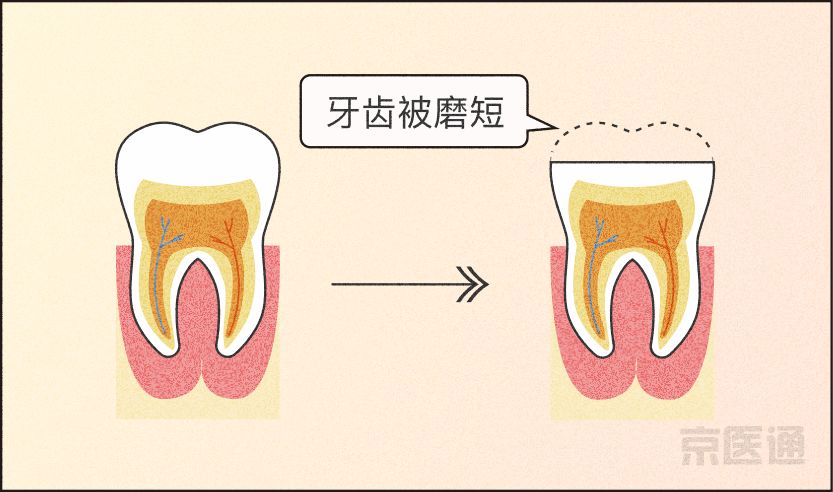 磨牙不好是真的吗,磨牙的危害与注意事项