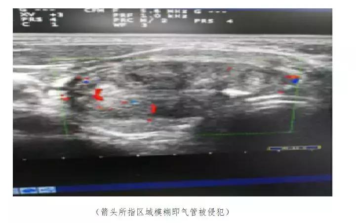 甲状腺结节十多年了会转癌吗,老人得甲状腺结节是怎么回事