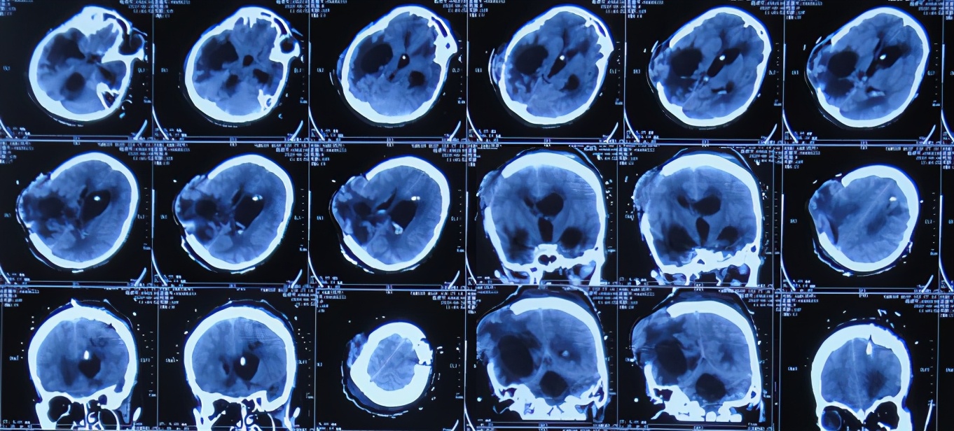 脑室有粘连脑积水有什么办法,脑动脉畸形手术后出现急性脑积水