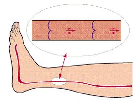 年轻女孩腿部静脉曲张,有年轻的女性得静脉曲张吗