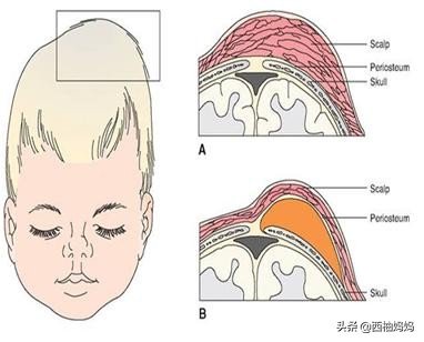 辟谣:“产瘤”十一天还没有消失,变硬就来不及了?要去抽出来?