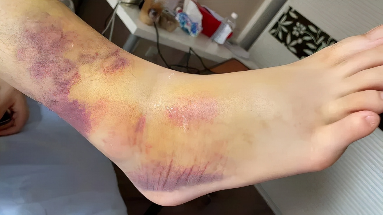 踝关节习惯性扭伤能治愈吗,踝关节扭伤是否伤到骨头