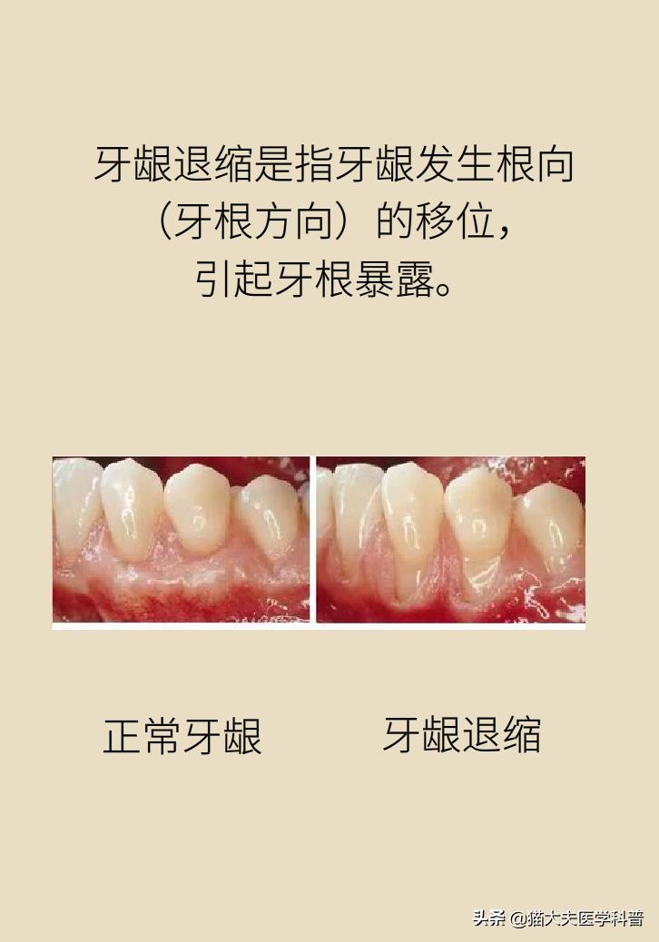 牙根露出来怎样修复不动刀,牙根暴露但没疼痛感怎么办