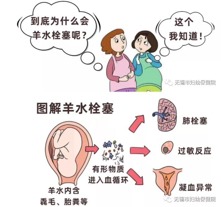 妇幼母婴科普,羊水栓塞都有谁抢救成功过