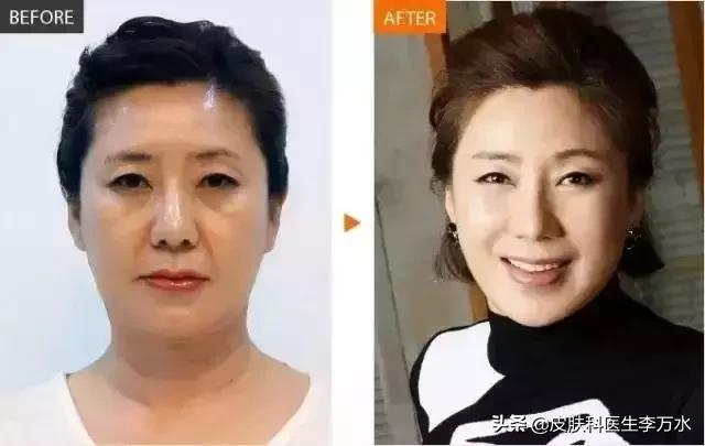 张雨绮说超声刀就像在烤肉?!线雕和超声刀,究竟哪个更靠谱?