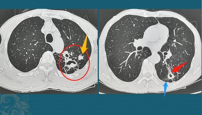 ct怎么判断肺结核有没有传染性,刚刚感染肺结核能从ct上看出来吗