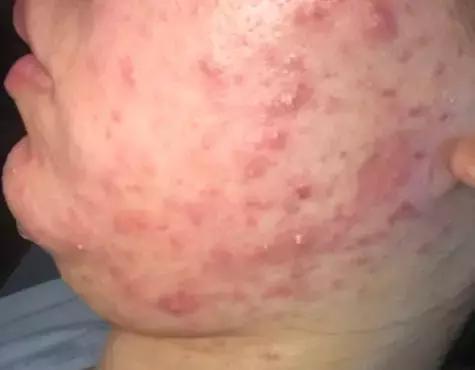 「许师解疑」难治性*疮痤**案析酸寒法