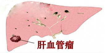 结节不用做手术，吃药就能好？这些情况需要注意