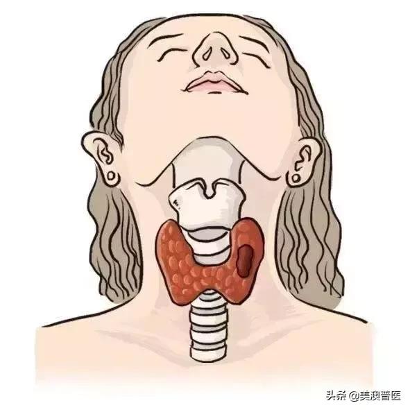 体检查出甲状腺结节该咋办,体检有甲状腺结节医生说没事