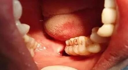 拔完牙最怕并发症,拔完牙之后的最严重的并发症
