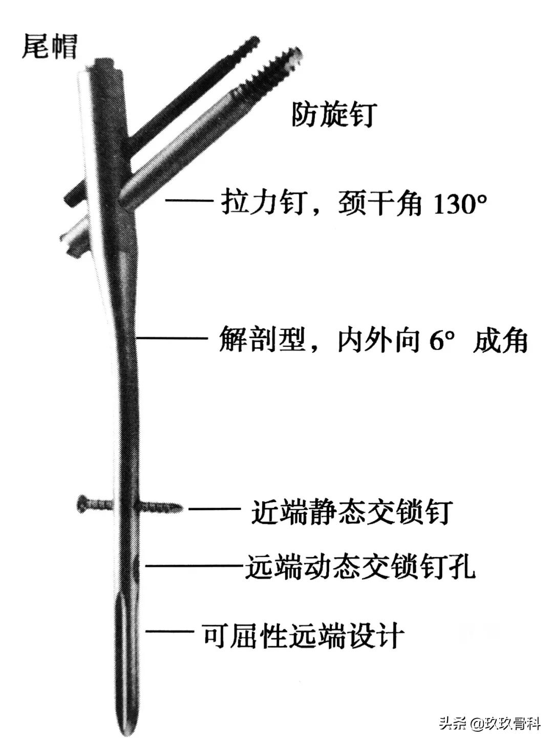 骨科取髓内钉的视频,骨科髓内钉内固定术式简写