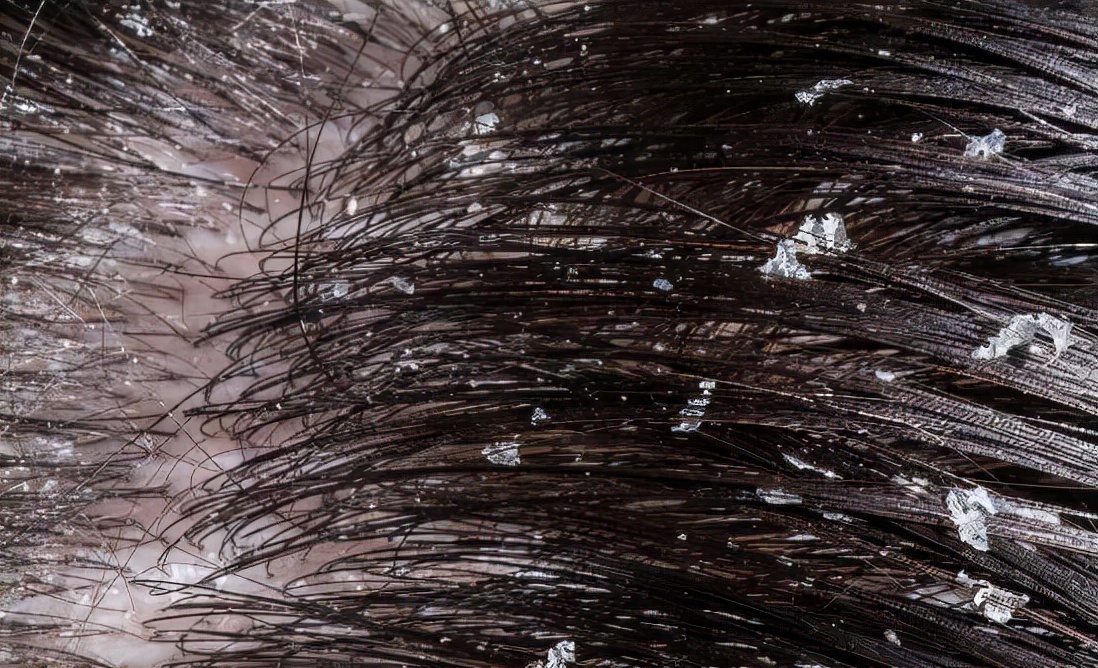 米诺地尔有什么副作用吗,米诺地尔副作用和禁忌