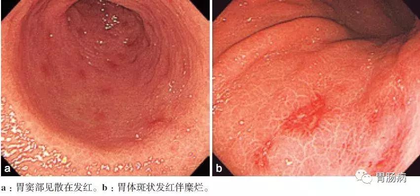 慢性浅表性非萎缩性胃炎伴糜烂,浅表性非萎缩胃炎吃什么药