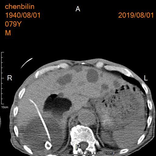 肝硬化肝囊肿要治疗吗,肝包虫囊肿与肝囊肿