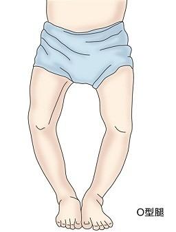 膝外翻超过15度怎么办,膝内翻或膝外翻的原因